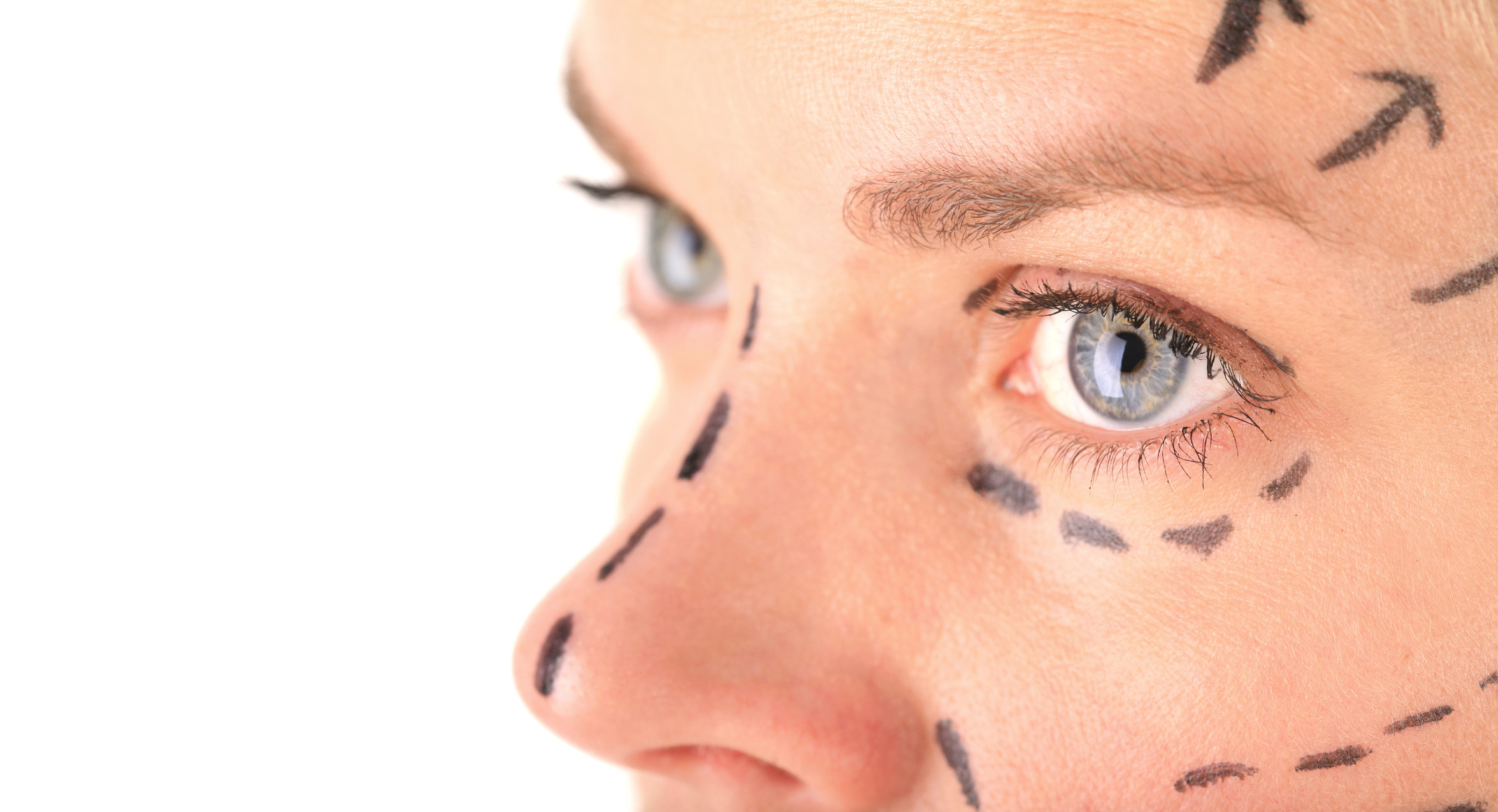 Close up image of a woman's face with dashed lines drawn on on in preparation for a face lift.