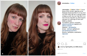 instagram screen shot of woman showing before and after photo of her rosacea
