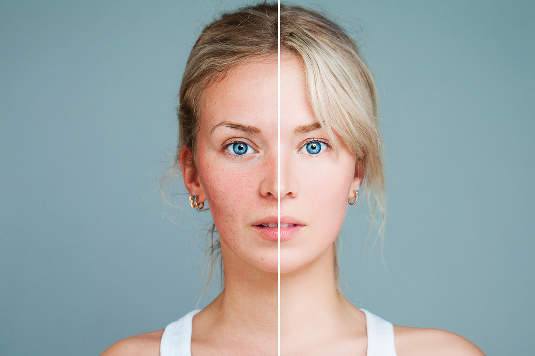 female face divided in two parts showing a side with healthy clear skin and another side with unhealthy irritated skin